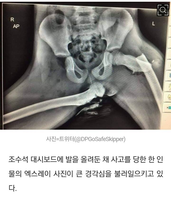 대시보드에 발 올린채로 사고난 사람의 X-RAY.jpg - 뽐뿌:자유게시판